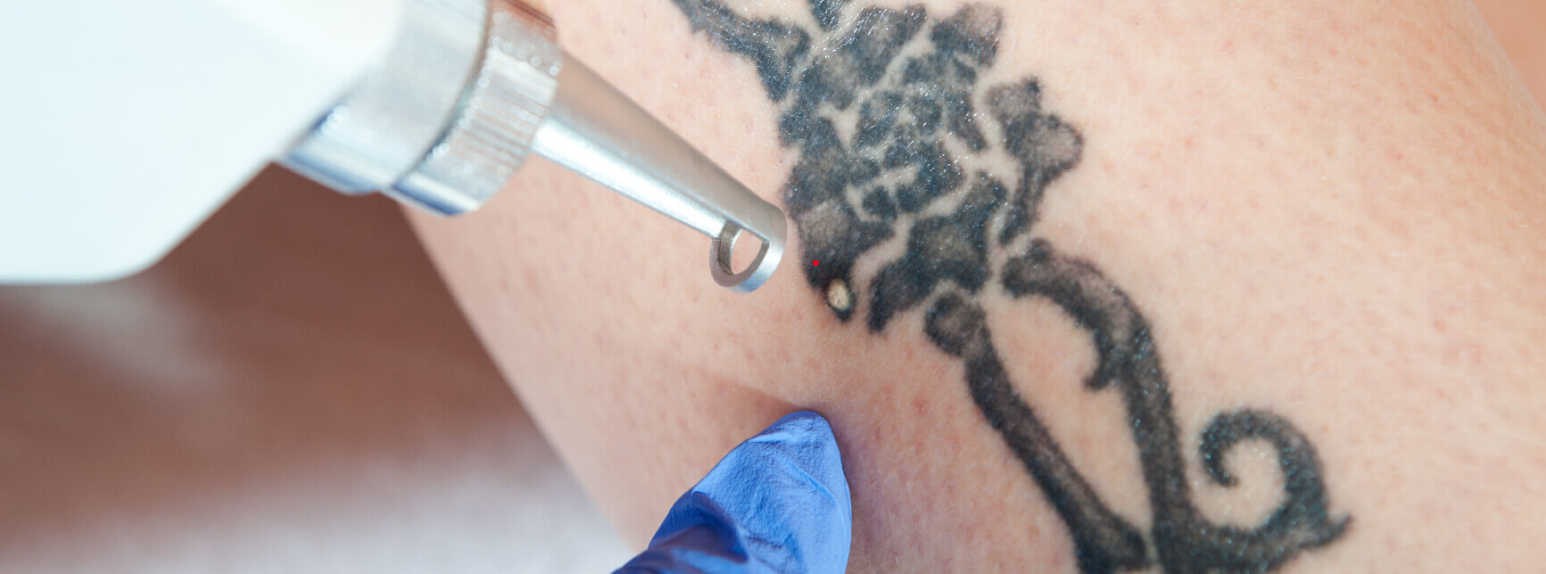 tattoo_removal